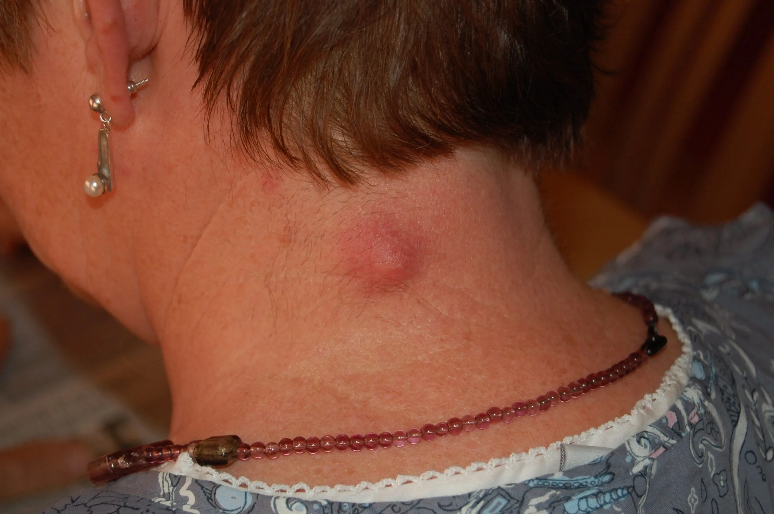 semaglutide after gallbladder removal reddit Ozempic Removal: Safety & Guidelines Weight loss now gallbladder. Had