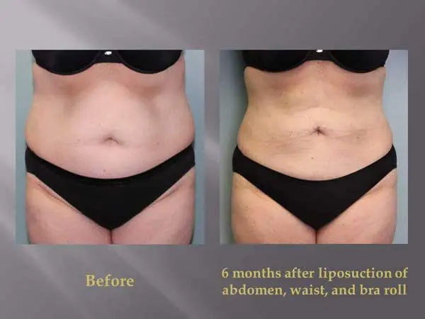 The Cost of Liposuction | Greer Plastic Surgery