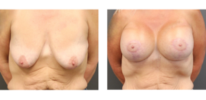 Patient who in her mid 40's and had a Mastopexy with Breast Aug. Size 580's.