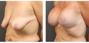 Patient who in her mid 40's and had a Mastopexy with Breast Aug. Size 580's.