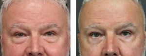 Patient is in his early 70's and had a blepharoplasty. Photos 3 months post op