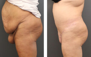 patient is in her mid 40's who had a Fleur-di-lis abdominoplasty, monsplasty and a medial thigh lift