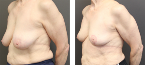 patient in her mid 70's that had a breast reduction and is 3 months post op